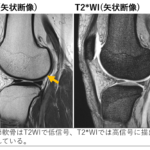 関節軟骨損傷のMRI画像診断のポイント